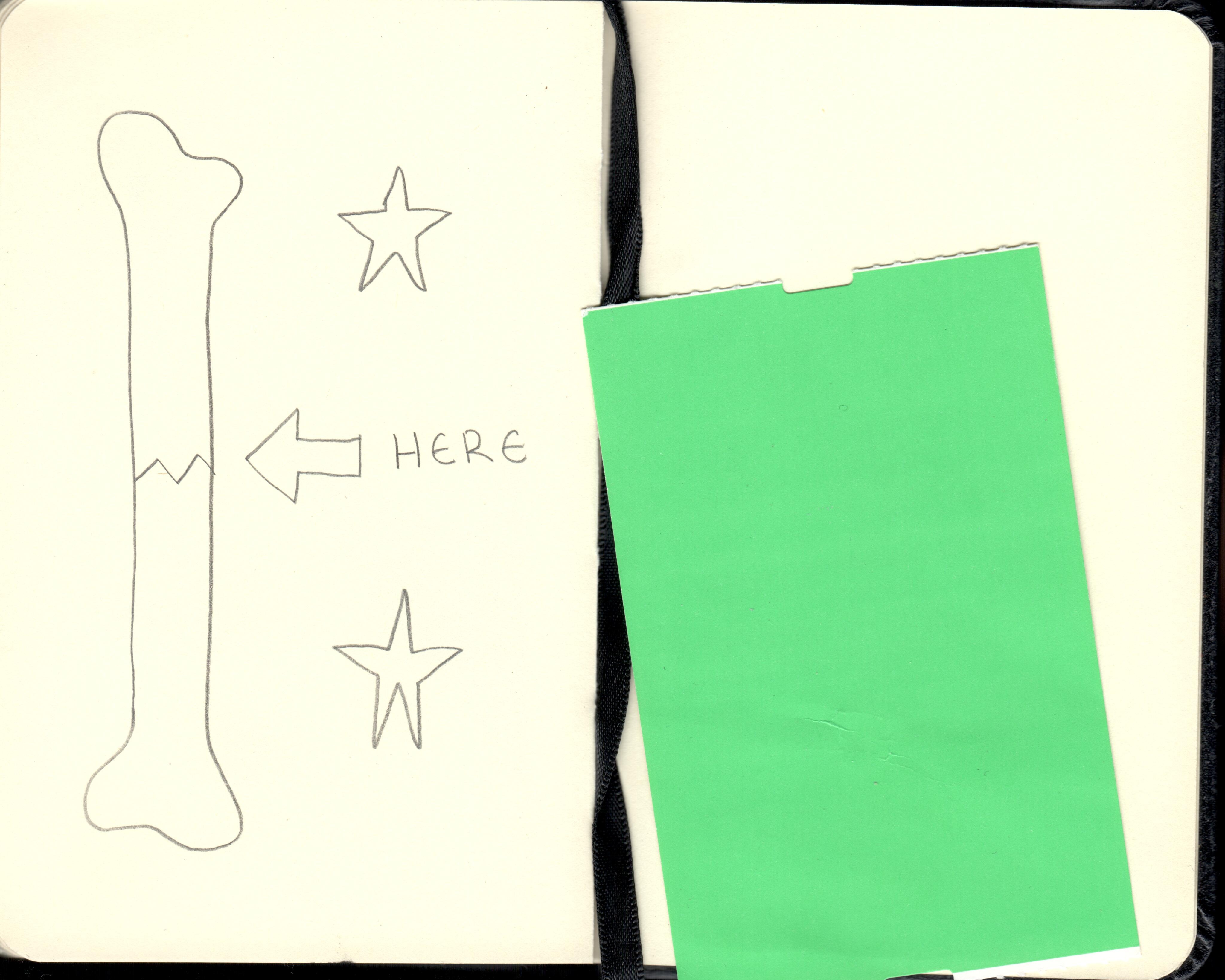 A drawing of a bone, broken in half. An arrow points to the break, above it is a text that reads: HERE. the text is surrounded by two stars
